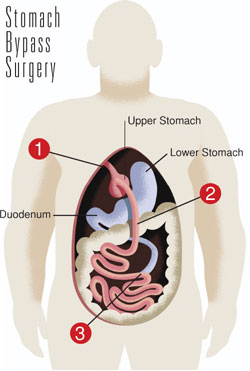 Left: Nancy Douglas before her bariatric surgery. Right: Nancy Douglas today, after losing more than 100 pounds of bodyweight. Photo by Kathy Sauber.