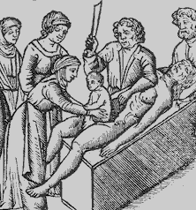 Alleged birth of Julius Caesar by Caesarean section