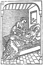 German woodcut depicting Caesarean birth